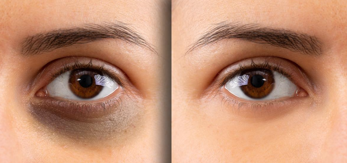 Dark Circle Removal Laser Treatments for Brighter, Youthful Under-Eye Skin Screenshot 2026 01 20 112829